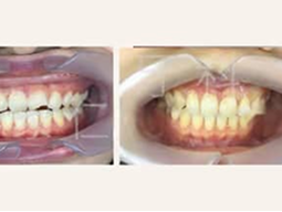 Dent ébréchée ? Traitements, réparations et tarifs pour les dents de devant et les molaires